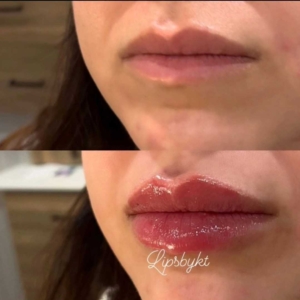 Detailed view of enhanced lip volume post-treatment, illustrating the benefits of our Post-Lip Injection Guidelines.