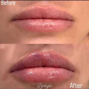 Before and after comparison of lip filler results, showcasing the efficacy of following Lip Filler Aftercare Tips from Five Elements Spa.