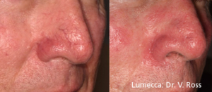 Lumecca IPL Skin Rejuvenation