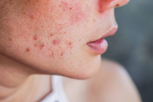 Close-up of a person's cheek showing red acne and scarring.