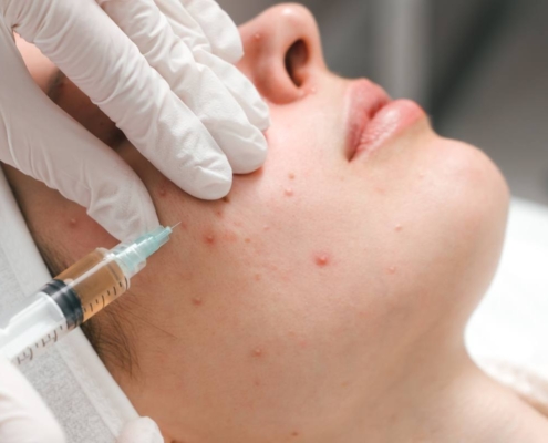 A close-up of a dermatological procedure with a medical professional injecting treatment into the acne-affected skin of a patient.