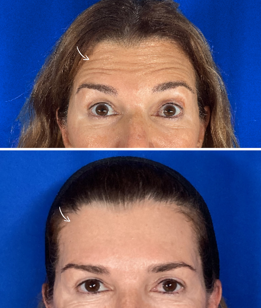 botox-img-2