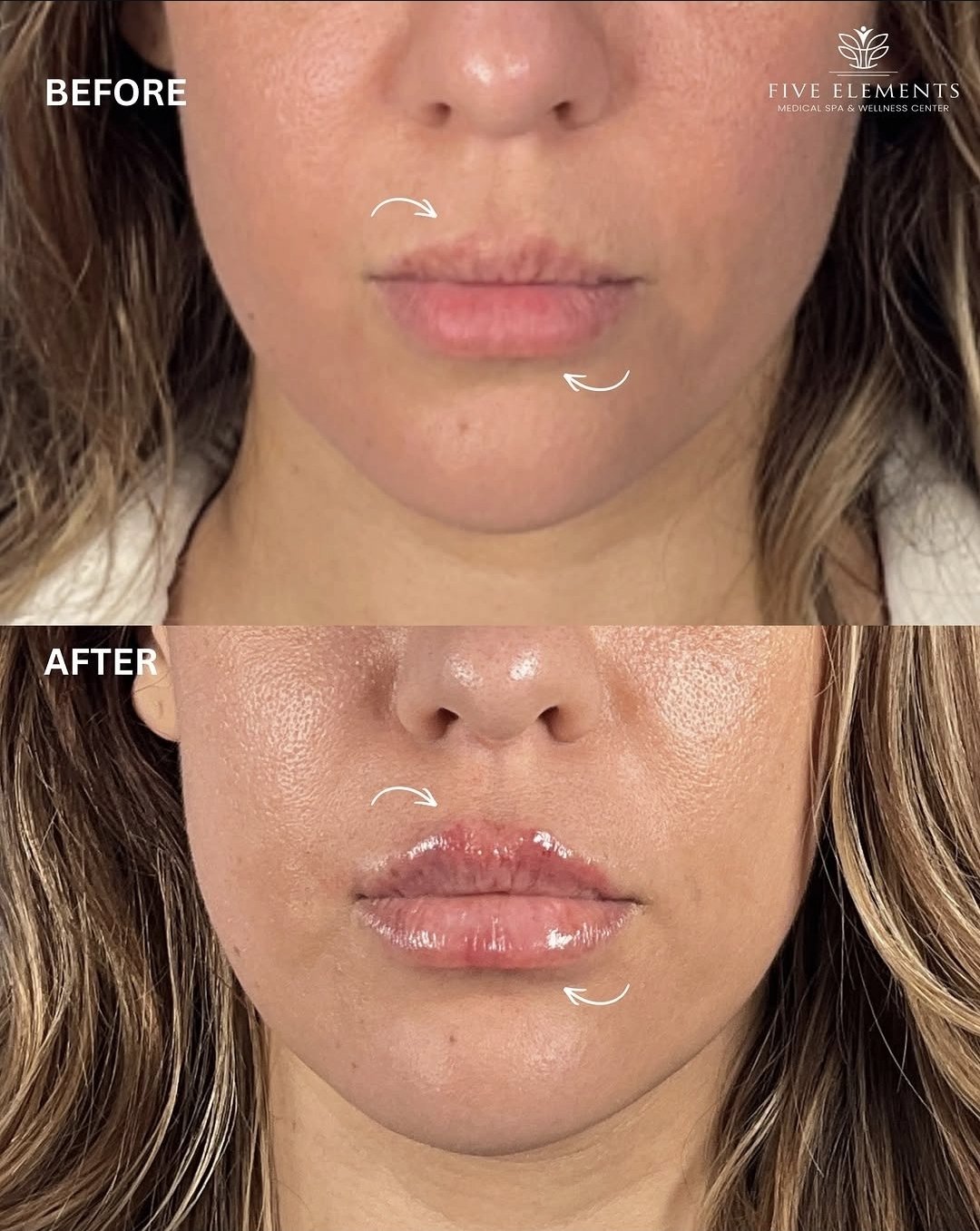 Before and after lip filler at Five Elements Medical Spa & Wellness Center