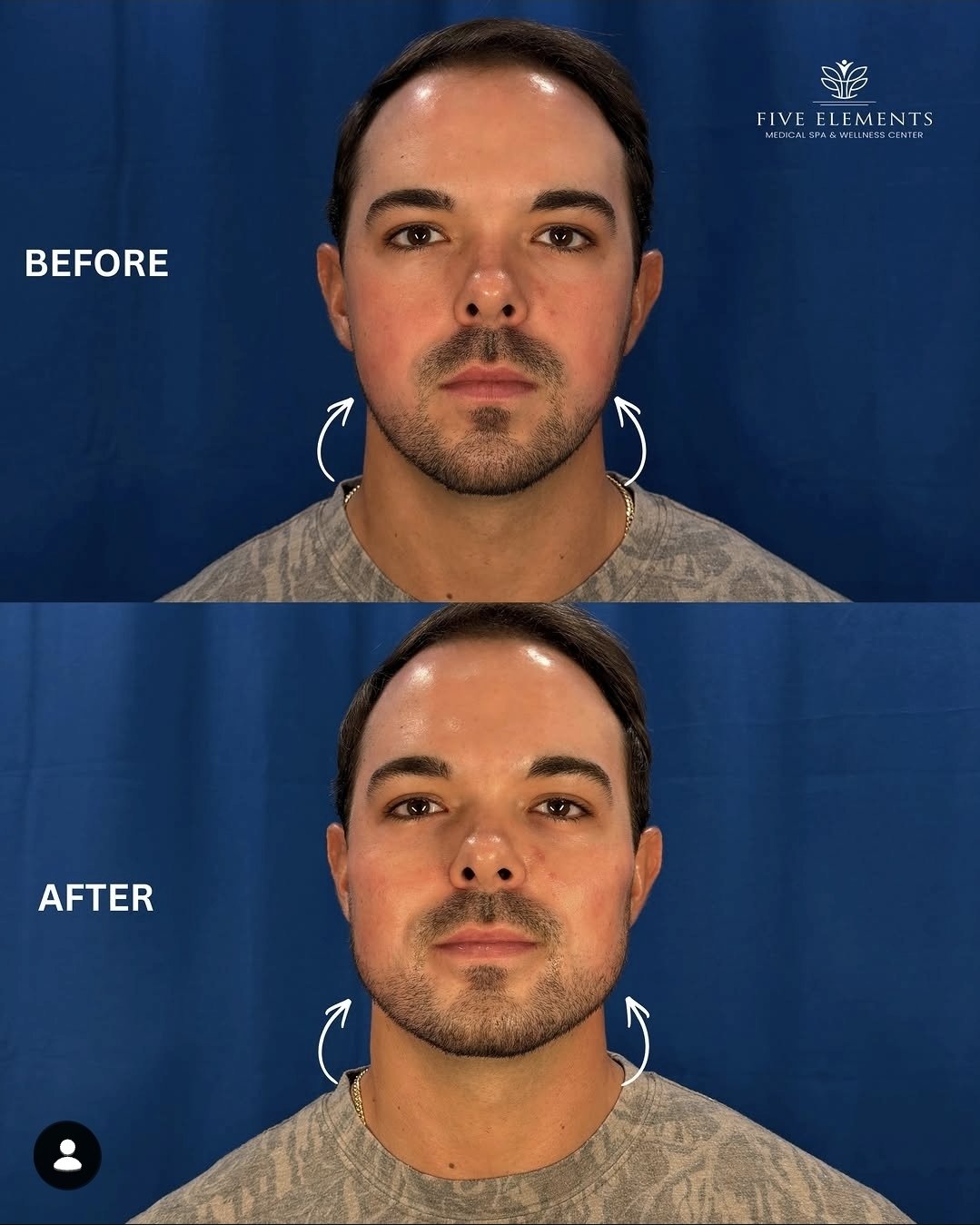 Before and after jawline filler at Five Elements Medical Spa & Wellness Center